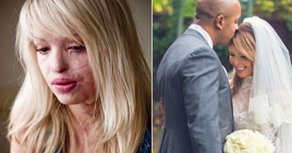 Ten Years Ago, Her Ex Raped Her and Threw Acid on Her Face, Destroy Her Life Almost – but Take A Look at Her Now