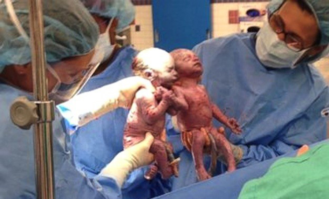 Mother Gives Birth to Rare ‘Mono Mono’ Twins Holding Hands