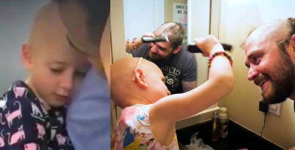 Little Girl Suffers from Alopecia, Dad Shaved His Hair Too! Being without Hair Is Nothing Important!