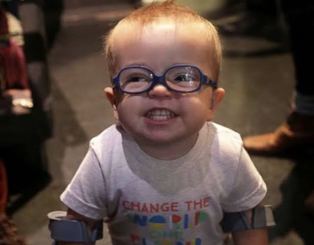 2-Year-Old Boy Born With Spina Bifida Learned To Walking Giving Joy To Followers