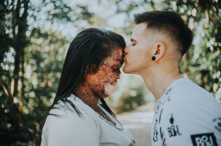 Woman With Skin Disease Blessed With Man Who Loves Her Inner Beauty