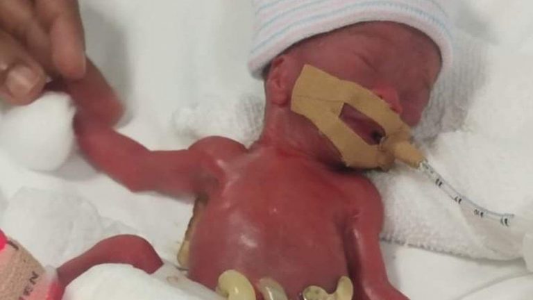 World’s smallest ever baby survives after being born weighing less than 1 lb