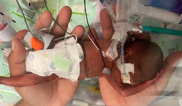 Baby Had A Less than 1% of Chance of Survival, Then The Record-Breaking Preemie Shocked Doctors and ‘Defied All Scientific Odds’