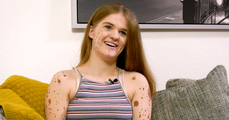 Girl Born with 500 Birthmarks Is Bullied over Her Appearance for Years and Now She Becomes A Model