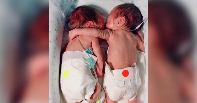 Nurse Puts Dying Baby Next To Her Twin. She Gives Her A ‘Hug’ That Leads to A Miracle