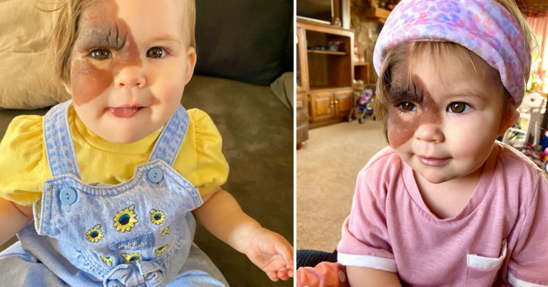 Mom on Mission to Show Daughter with a Rare Birthmark That She is Beautiful