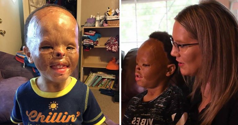 Foster Baby Is Adopted 7 Years after Apartment Fire Left Him with Horrific Burns